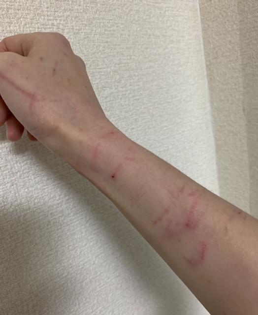 噛んでくるニャンコ 傷痕画像あります ろう子さんの猫ブログ ネコジルシ 噛んでくるニャンコ 傷痕画像あります ろう子さんの猫ブログ ネコジルシ